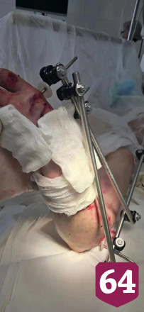 Врачи спасли травмированную станком руку саратовца
